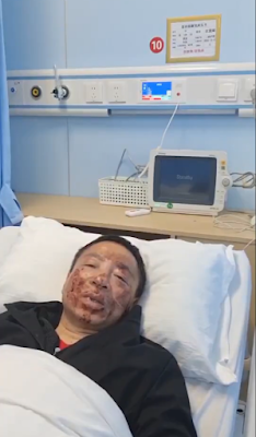 江蘇無錫維權人士沈愛斌在派出所遭警察毆打，鼻樑骨折